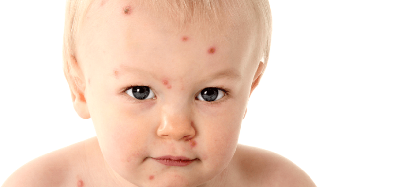 Chicken Pox Treatments – What’s the best one?